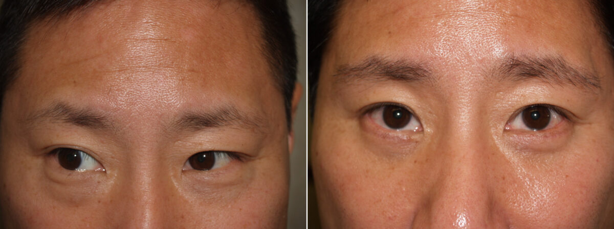 Facial Plastic Surgery Before and after in Miami, FL, Paciente 125692