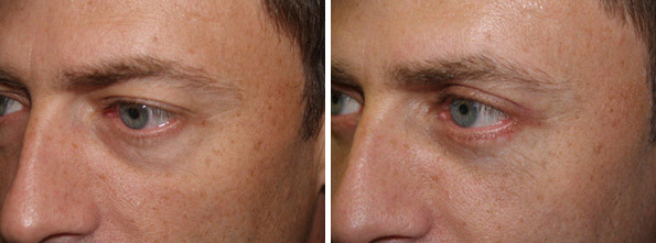 Facial Plastic Surgery Before and after in Miami, FL, Paciente 125699