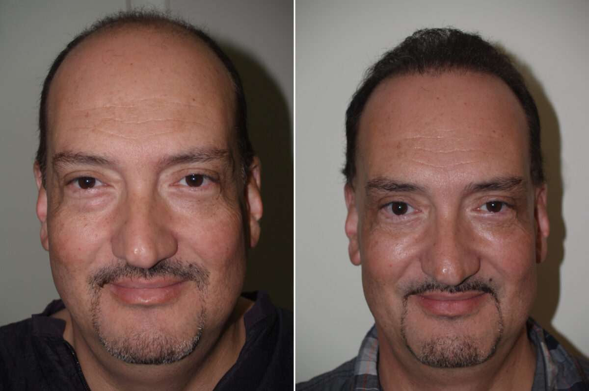 Facial Plastic Surgery Before and after in Miami, FL, Paciente 125706