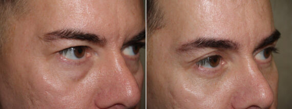 Facial Plastic Surgery Before and after in Miami, FL, Paciente 125719