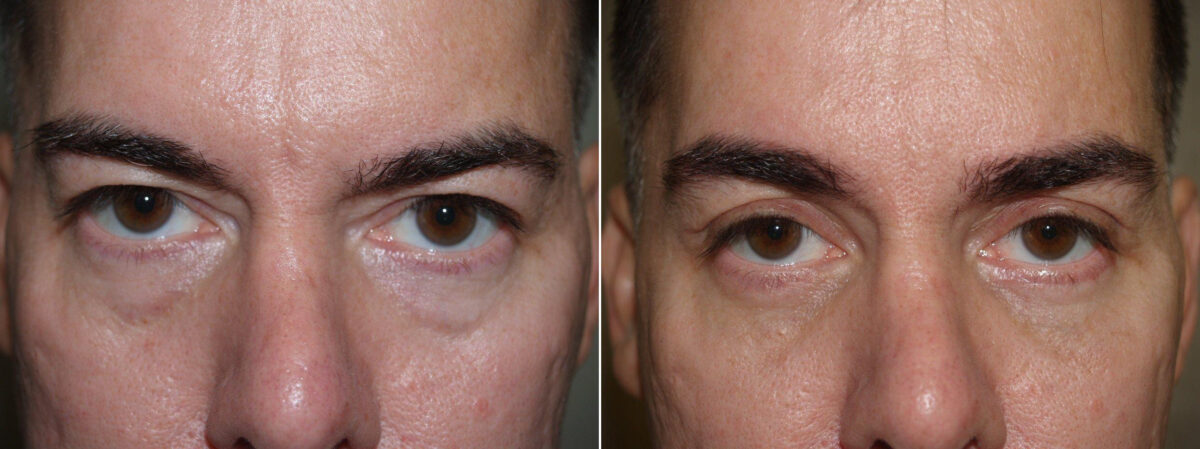 Facial Plastic Surgery Before and after in Miami, FL, Paciente 125719