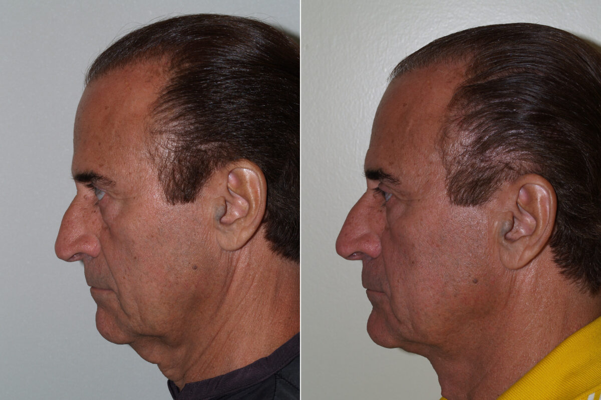 Facial Plastic Surgery Before and after in Miami, FL, Paciente 125732