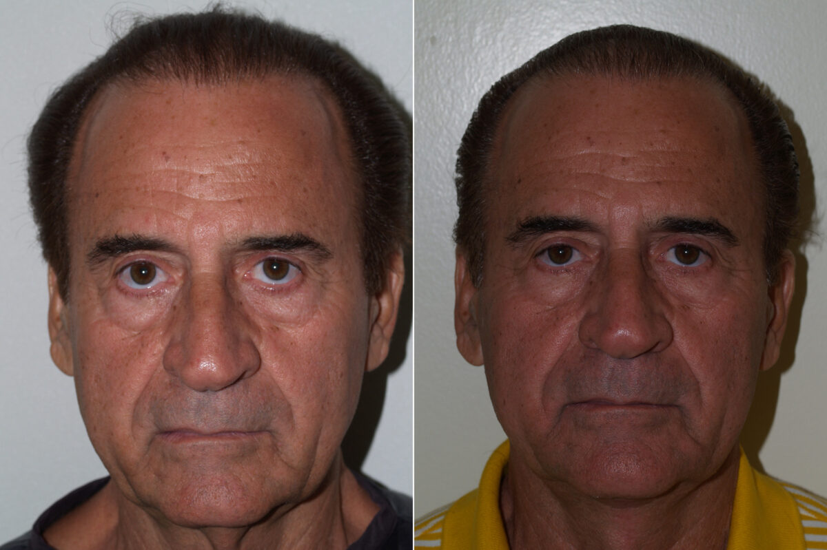 Facial Plastic Surgery Before and after in Miami, FL, Paciente 125732