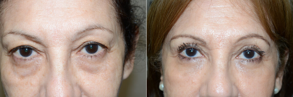 Facial Plastic Surgery Before and after in Miami, FL, Paciente 125783