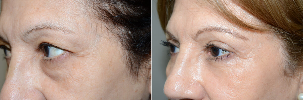 Facial Plastic Surgery Before and after in Miami, FL, Paciente 125783