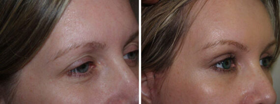 Facial Plastic Surgery Before and after in Miami, FL, Paciente 125802