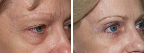 Facial Plastic Surgery Before and after in Miami, FL, Paciente 125815