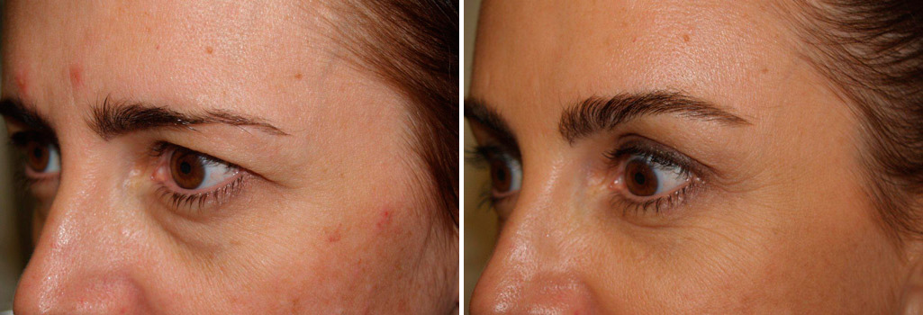 Facial Plastic Surgery Before and after in Miami, FL, Paciente 125822