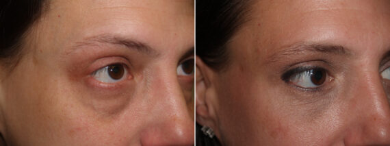 Facial Plastic Surgery Before and after in Miami, FL, Paciente 125833