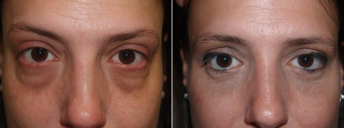 Facial Plastic Surgery Before and after in Miami, FL, Paciente 125833