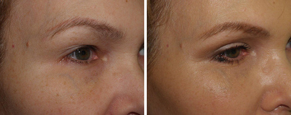 Facial Plastic Surgery Before and after in Miami, FL, Paciente 125864