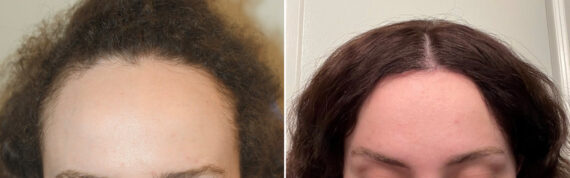 Forehead Reduction Surgery Before and after in Miami, FL, Paciente 125871