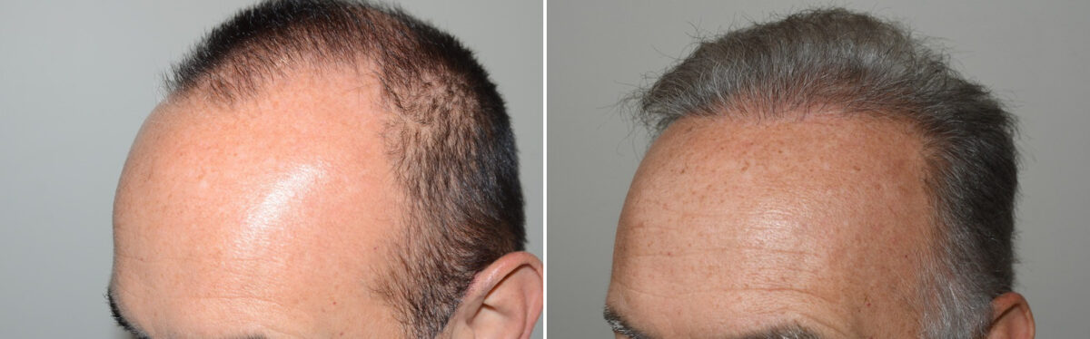Hair Transplants for Men Before and after in Miami, FL, Paciente 125891