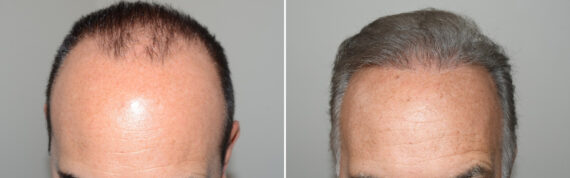 Hair Transplants for Men Before and after in Miami, FL, Paciente 125891