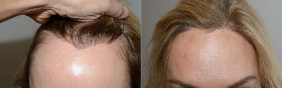 Hair Transplants for Women Before and after in Miami, FL, Paciente 125910