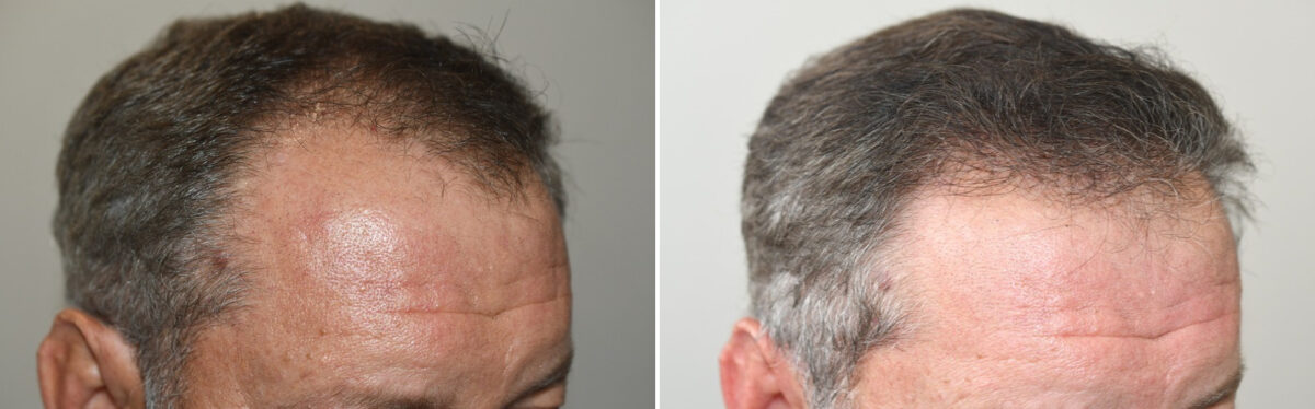 Hair Transplants for Men Before and after in Miami, FL, Paciente 125931
