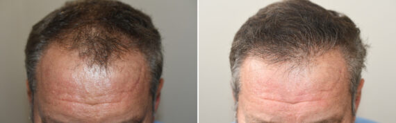 Hair Transplants for Men Before and after in Miami, FL, Paciente 125931