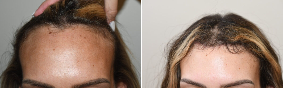 Forehead Reduction Surgery Before and after in Miami, FL, Paciente 125944
