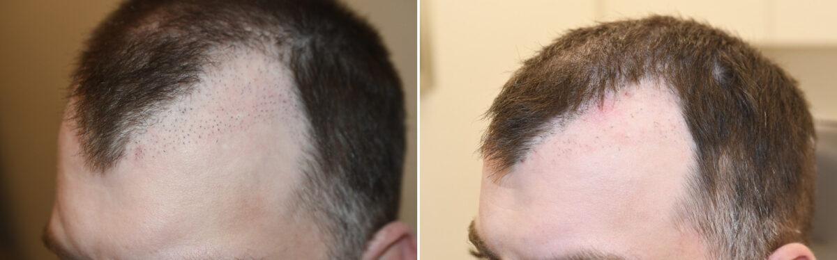 Hair Transplants for Men Before and after in Miami, FL, Paciente 125963