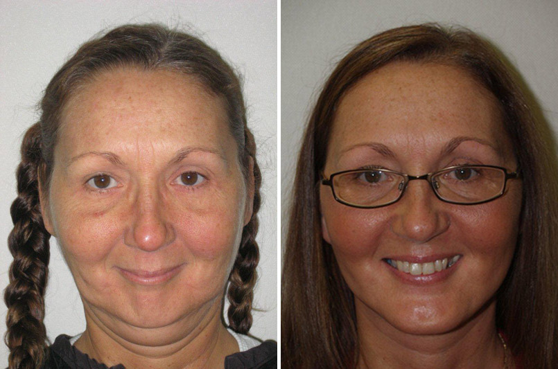 Facial Plastic Surgery Before and after in Miami, FL, Paciente 126014