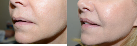 Facial Plastic Surgery Before and after in Miami, FL, Paciente 126027