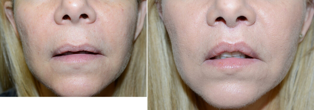 Facial Plastic Surgery Before and after in Miami, FL, Paciente 126027