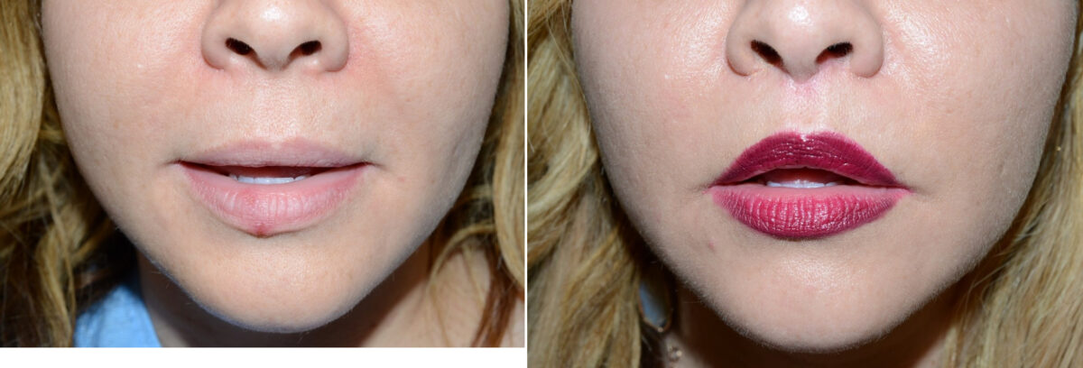 Facial Plastic Surgery Before and after in Miami, FL, Paciente 126065