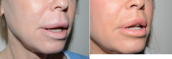 Facial Plastic Surgery Before and after in Miami, FL, Paciente 126068