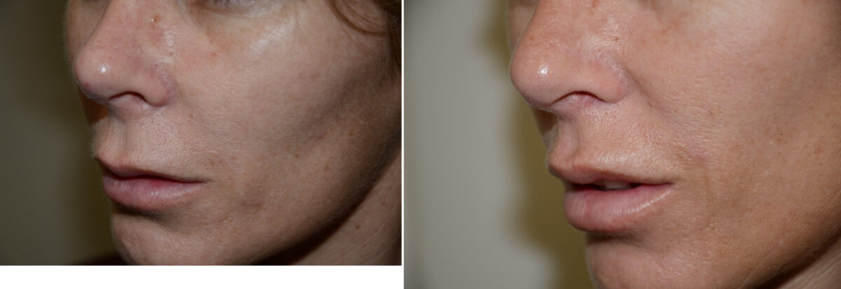 Facial Plastic Surgery Before and after in Miami, FL, Paciente 126071