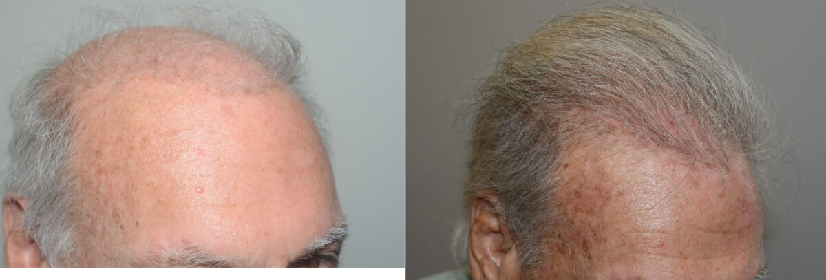 Body Hair Transplant Before and after in Miami, FL, Paciente 126157