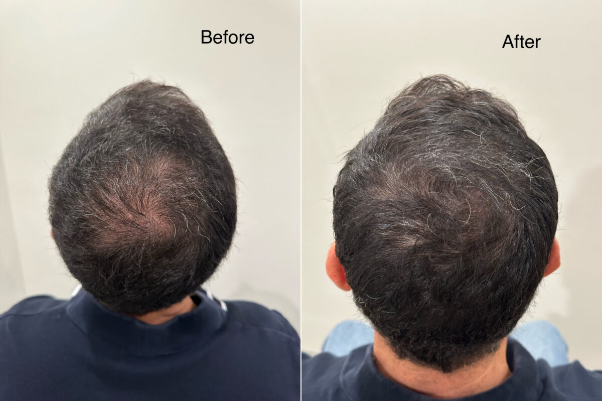 Scalp Micropigmentation Before and after in Miami, FL, Paciente 126189