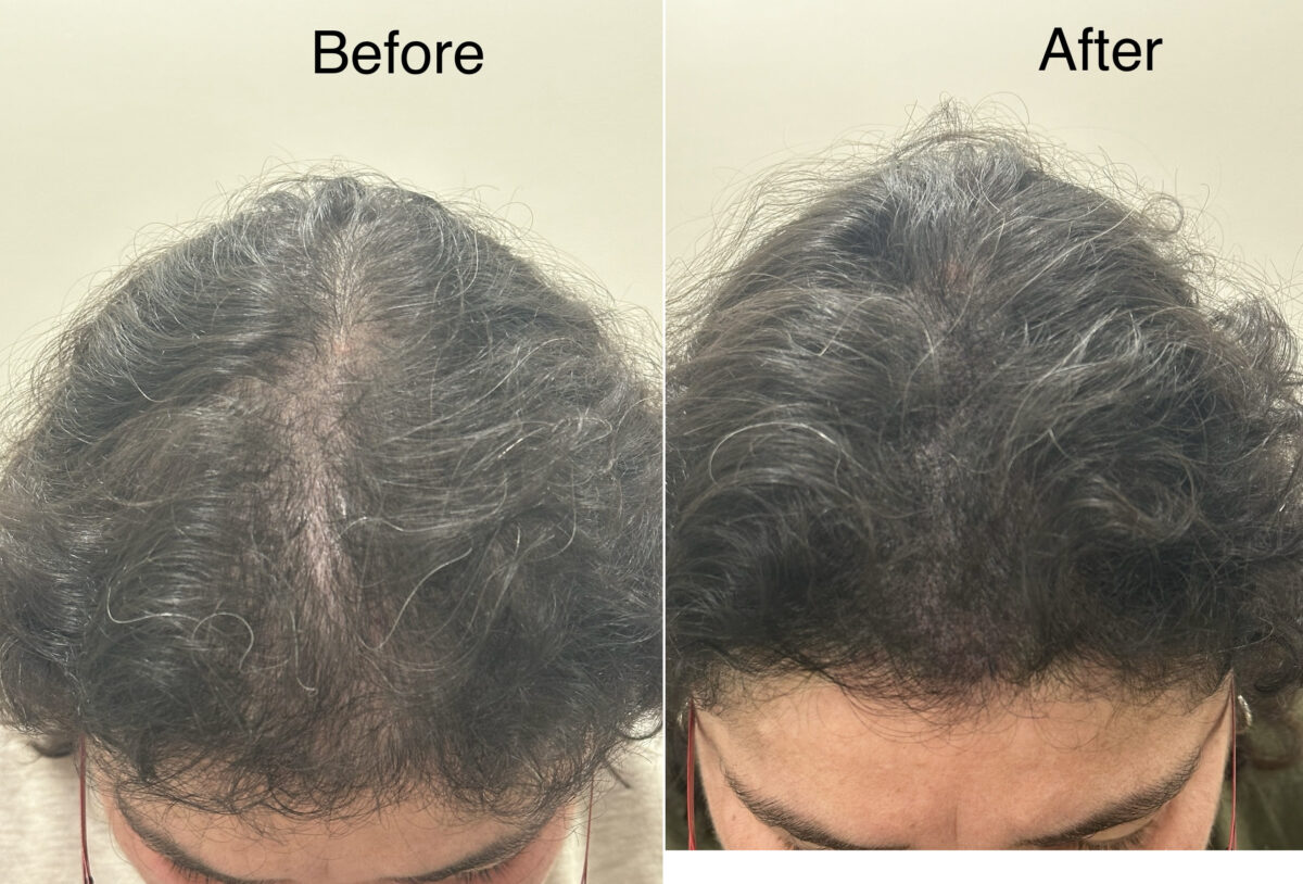 Scalp Micropigmentation Before and after in Miami, FL, Paciente 126192