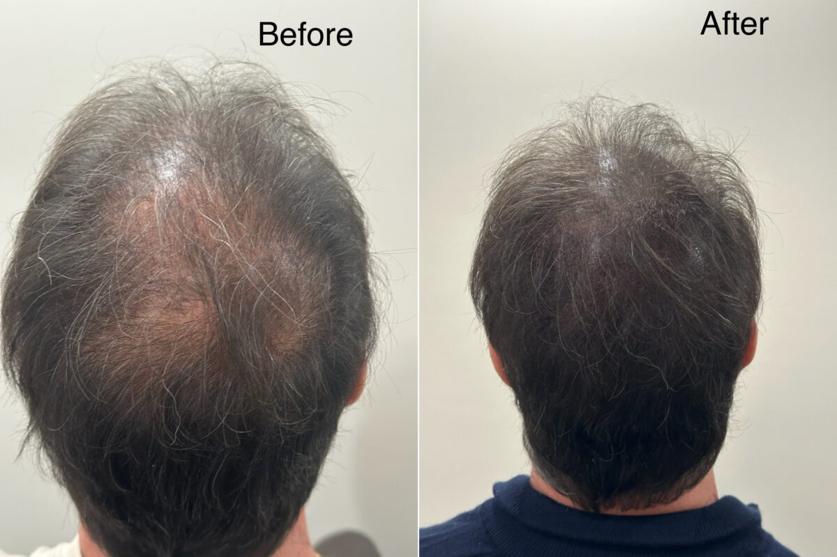 Scalp Micropigmentation Before and after in Miami, FL, Paciente 126195