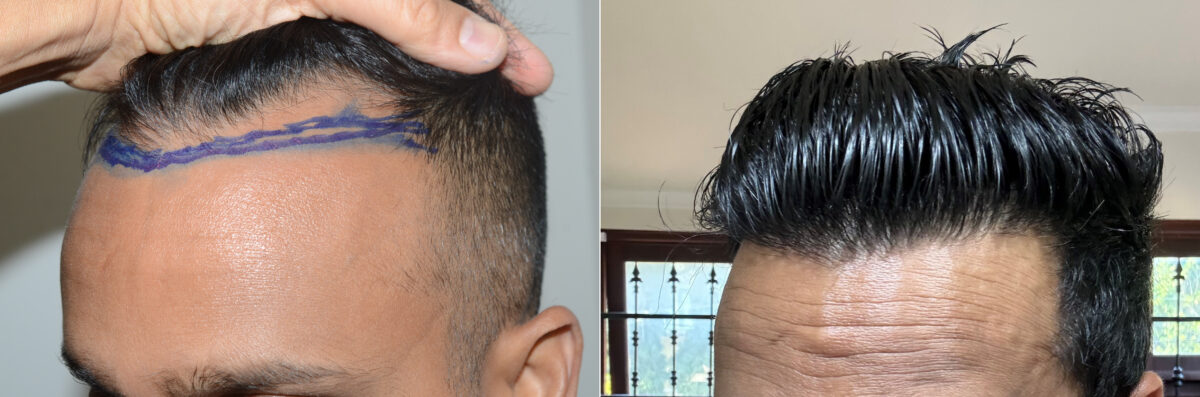 Hair Transplants for Men Before and after in Miami, FL, Paciente 126256