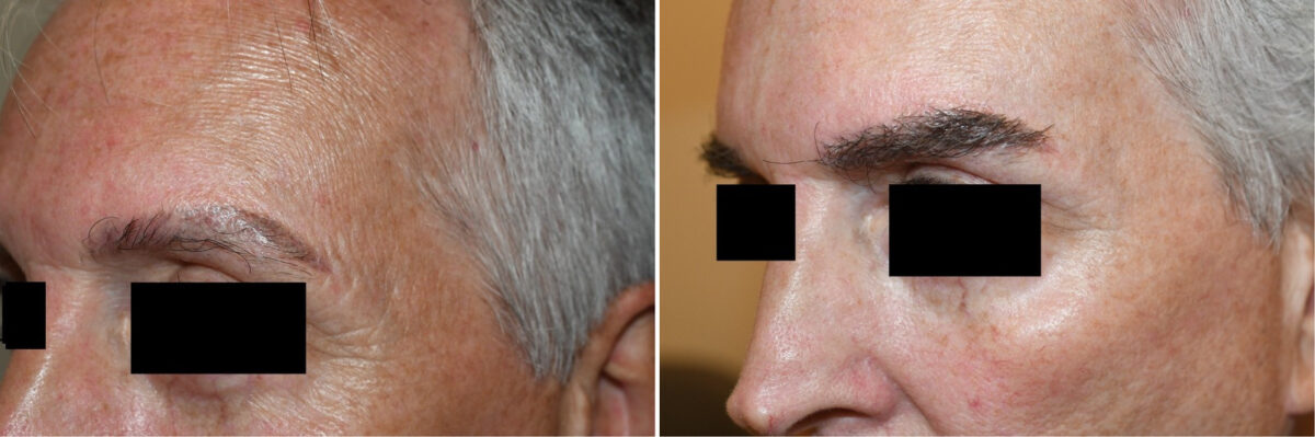 Eyebrow Hair Transplant Before and after in Miami, FL, Paciente 126380