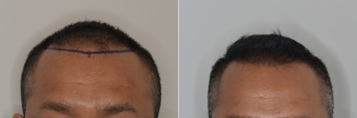 Hair Transplants for Men Before and after in Miami, FL, Paciente 126442