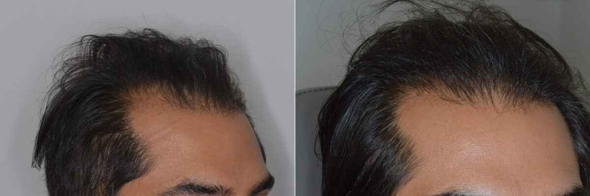 Hair Transplants for Men Before and after in Miami, FL, Paciente 126451