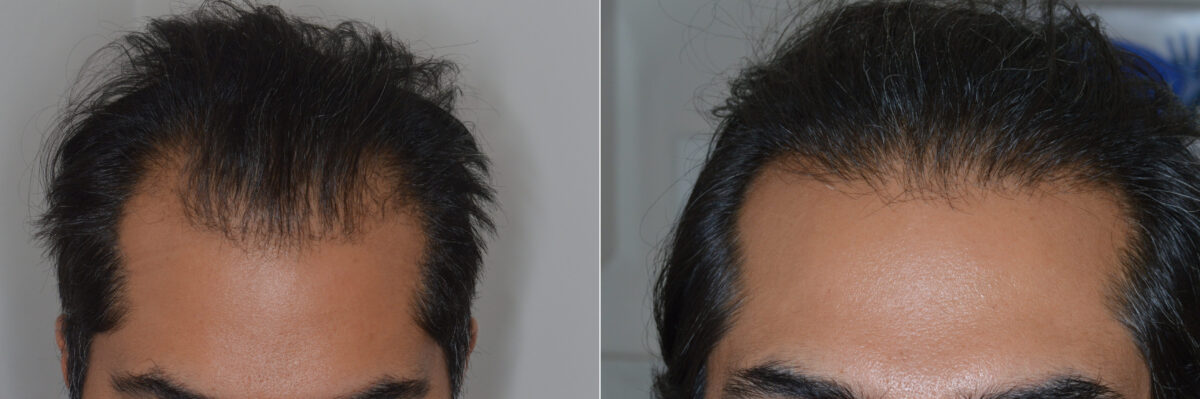 Hair Transplants for Men Before and after in Miami, FL, Paciente 126451