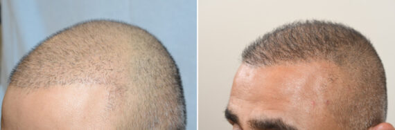 Body Hair Transplant Before and after in Miami, FL, Paciente 126515