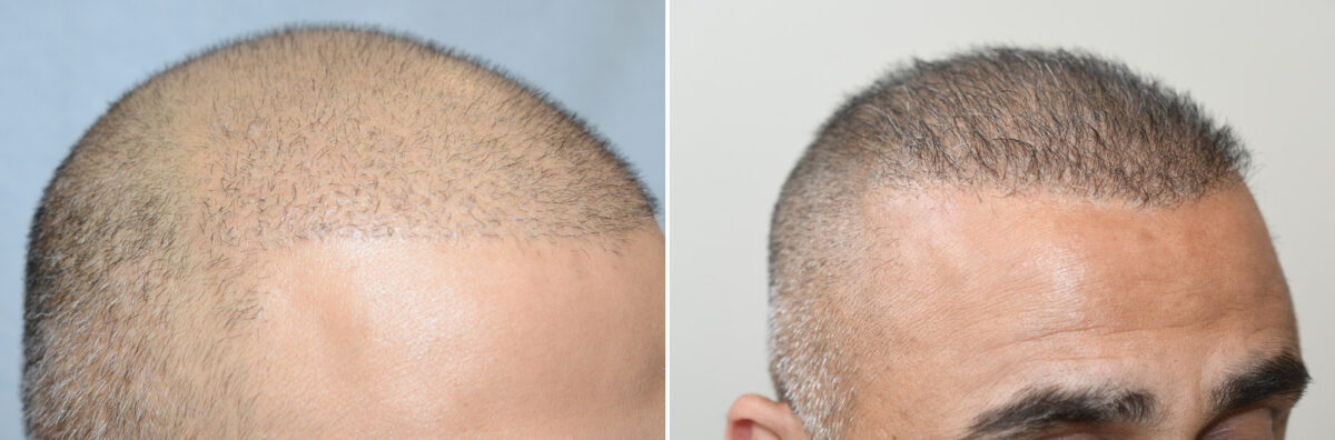 Body Hair Transplant Before and after in Miami, FL, Paciente 126515