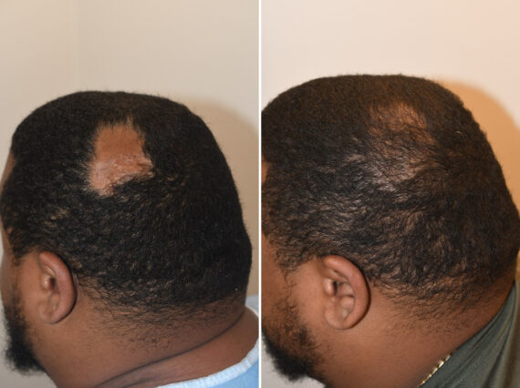 Hair Transplants for Men Before and after in Miami, FL, Paciente 126534