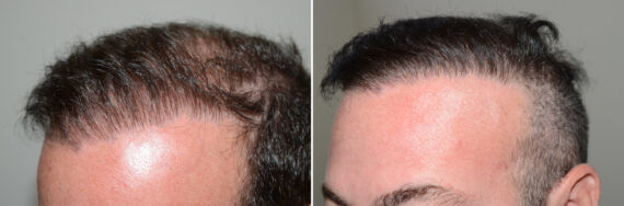 Reparative Hair Transplant Before and after in Miami, FL, Paciente 126541