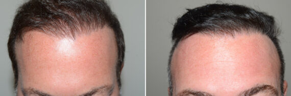 Reparative Hair Transplant Before and after in Miami, FL, Paciente 126541