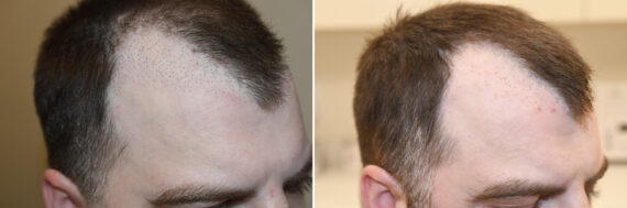 Reparative Hair Transplant Before and after in Miami, FL, Paciente 126554