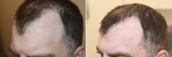 Reparative Hair Transplant Before and after in Miami, FL, Paciente 126554