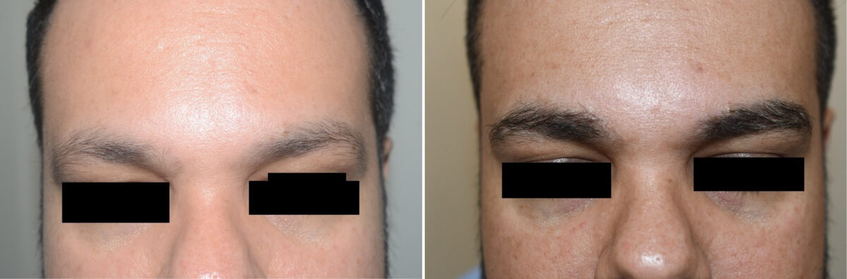 Eyebrow Hair Transplant Before and after in Miami, FL, Paciente 126567