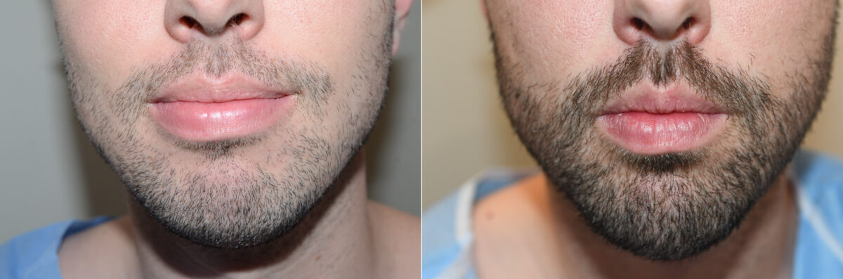 Facial Hair Transplant Before and after in Miami, FL, Paciente 126588