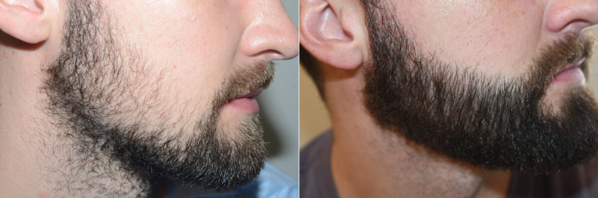 Facial Hair Transplant Before and after in Miami, FL, Paciente 126631