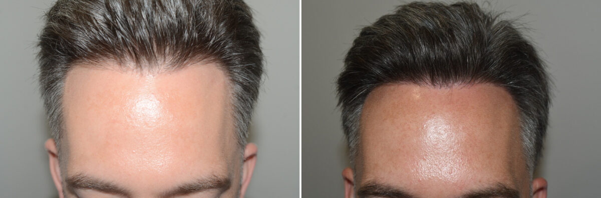 Hair Transplants for Men Before and after in Miami, FL, Paciente 126652