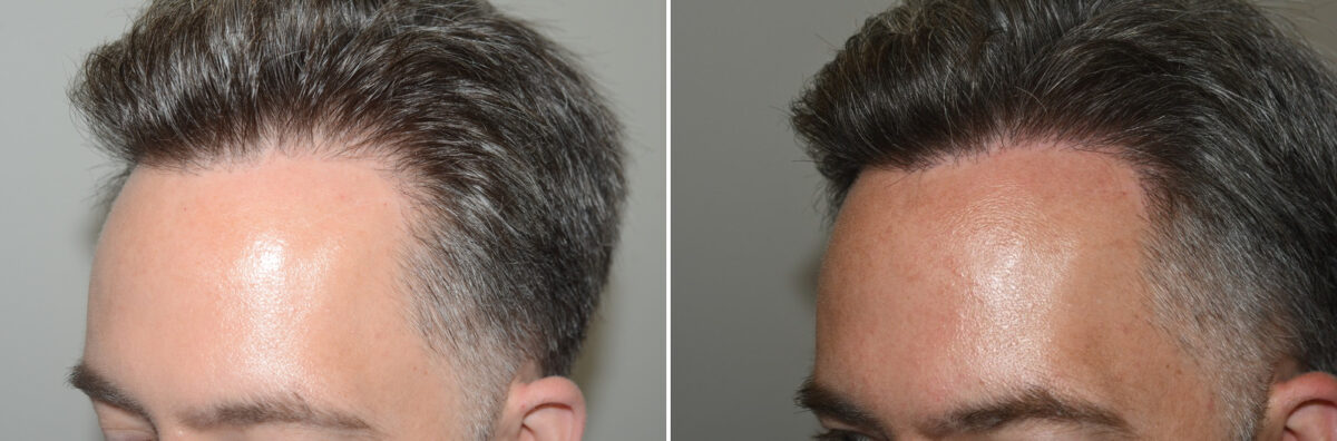 Hair Transplants for Men Before and after in Miami, FL, Paciente 126652